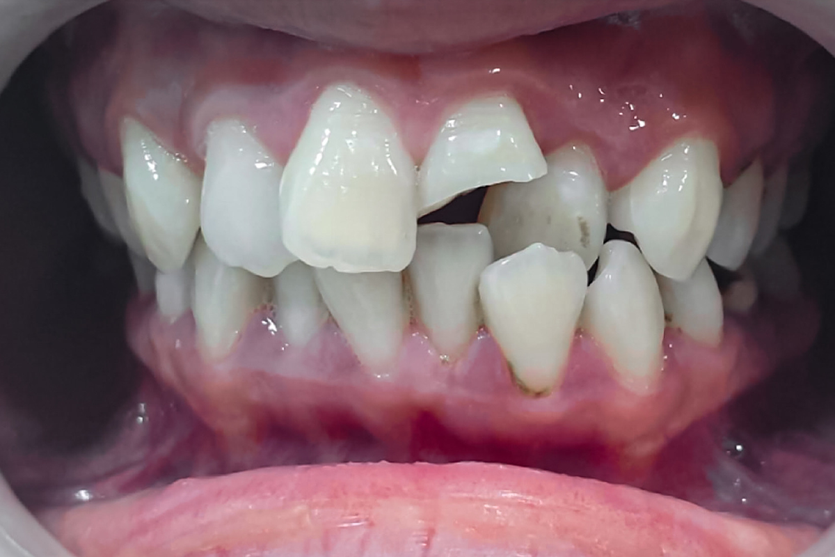 Root Canal Treatment 3