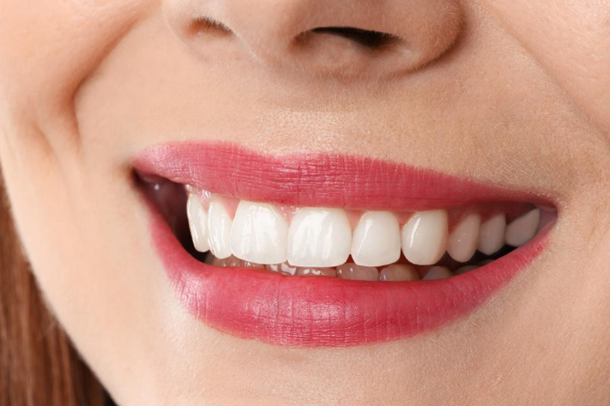 Teeth Cleaning & Polishing 1