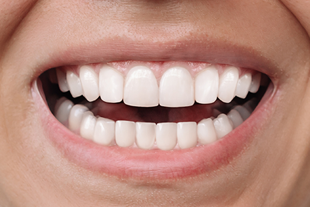 Teeth Cleaning & Polishing