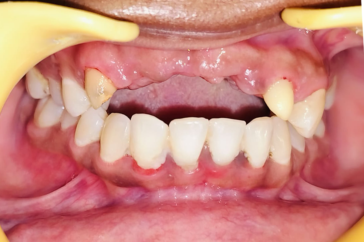 root canal treatment before